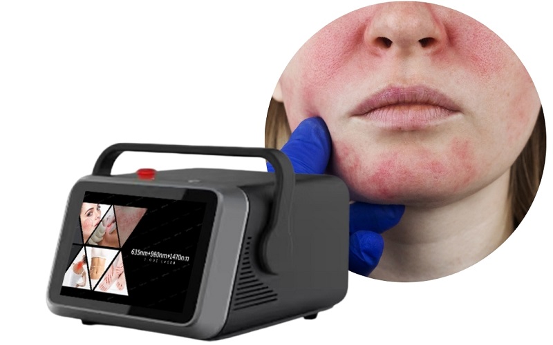 <b>PrismaLift 980nm 1470nm 635nm Diode Laser</b>