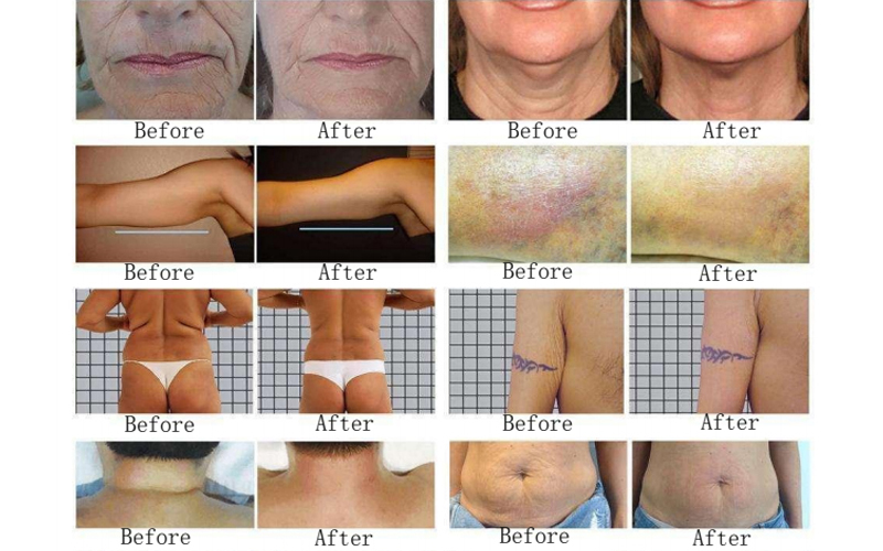 rotary negative pressure RF Machine for fat buring removal cellulite