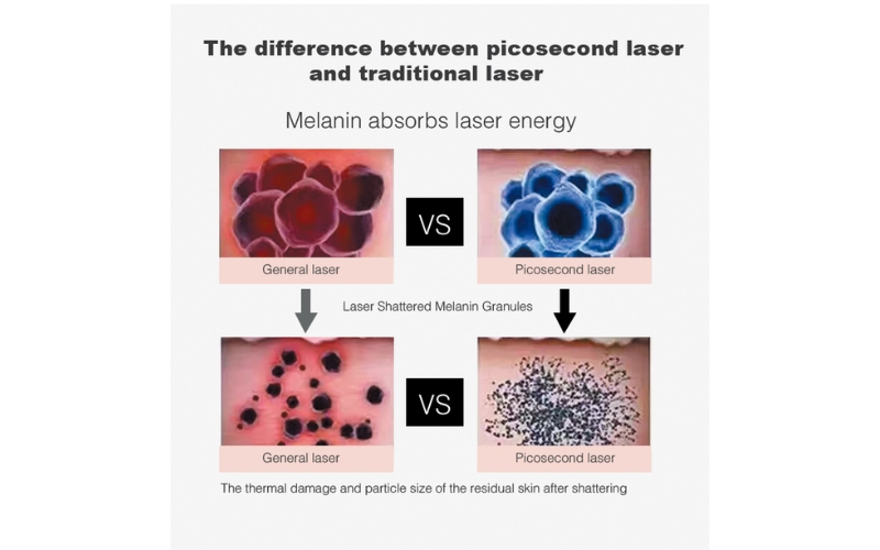 2025 Gomecy Pico Laser Air Cooling Q Switch Nd Yag Laser All Colors Tattoo Removal Machine