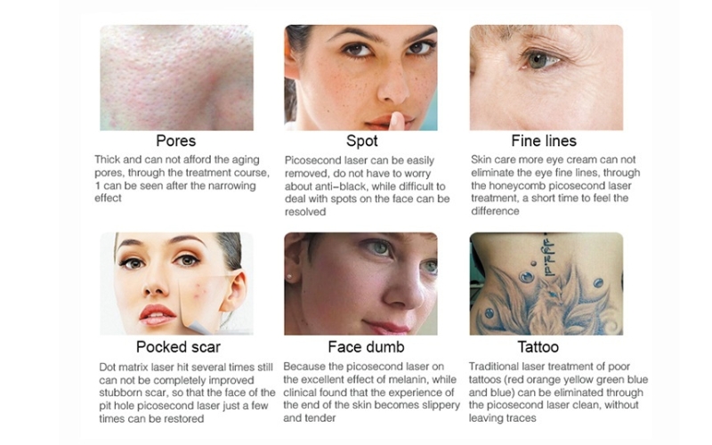 2025 Gomecy Pico Laser Air Cooling Q Switch Nd Yag Laser All Colors Tattoo Removal Machine