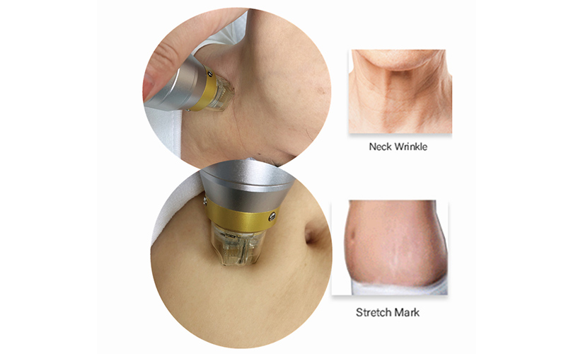 Fractional RF Microneedle